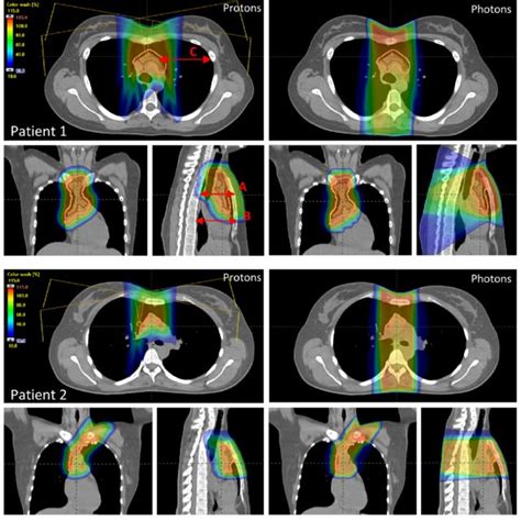 Proton Left And Photon Right Dose Distributions For Patient 1 Download Scientific Diagram