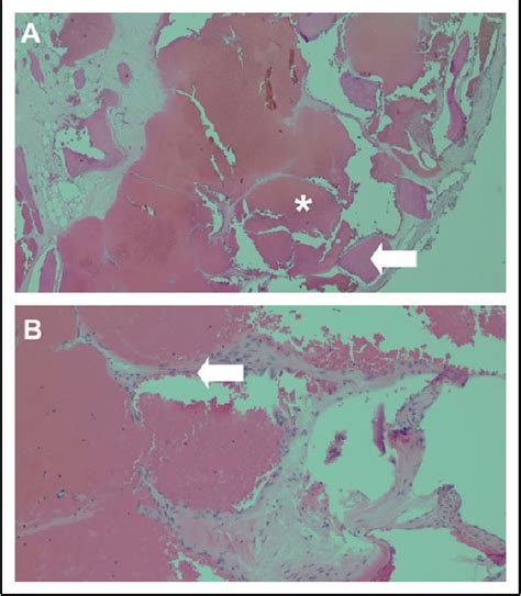 Intraosseous Hemangioma Of The Ethmoid Sinus Semantic Scholar