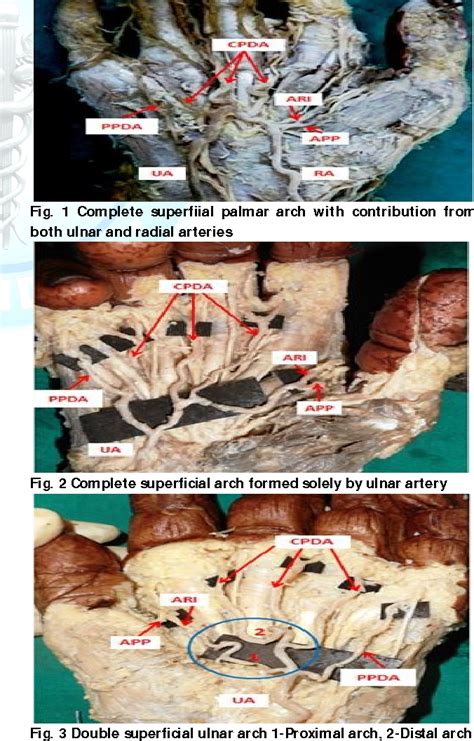 Figure From Pattern Of Variations In Superficial Palmar Arch And Its