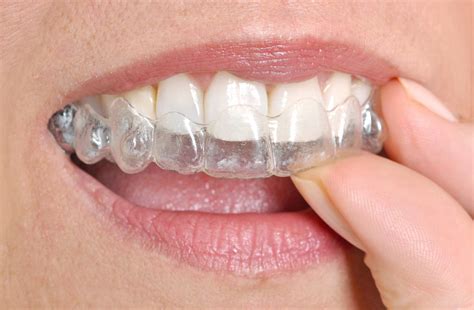 Why Invisible Braces Should Be Your Choice For Teeth Straightening