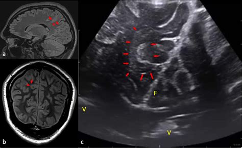 Intraoperative Definition Of Bottom Of Sulcus Dysplasia Using