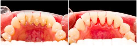 Placa bacteriana Qué es y cómo combatirla Periodontium