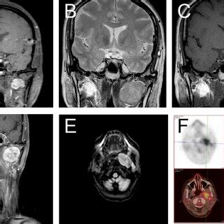 Morphological Findings Of The Solitary Fibrous Tumor Hemangiopericytoma