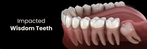 Impacted Wisdom Teeth Causes Symptoms Complications