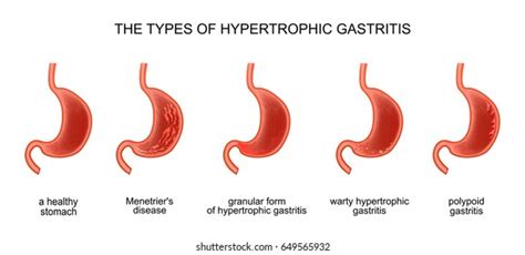 Vector Illustration Types Hypertrophic Gastritis Stock Vector Royalty