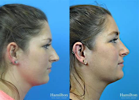 Rhinoplasty Before And After Gallery Patient 29