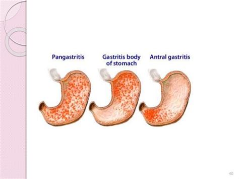 Stomach Pathology Lecture