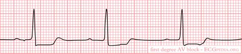 First degree AV block EKG examples - wikidoc