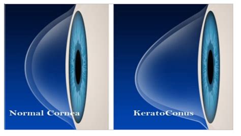 Collagen Cross Linking Cornea