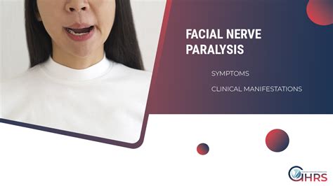 FACIAL NERVE PARALYSIS