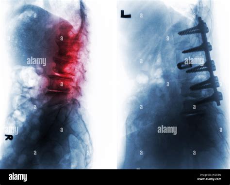 La Spondylolyse Film X Ray De La Colonne Lombaire Et La Comparaison