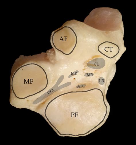 Figure 1 From The Evolution Of Sinus Tarsi Syndrome—what Is The Underlying Pathology—a Critical