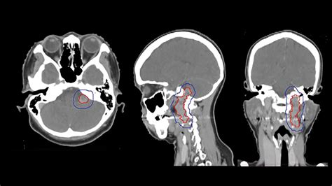 Paraganglioma of the skull base treated with intensity-modulated radiation therapy | Applied ...