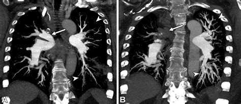 Multidisciplinary Approach To Chronic Thromboembolic Pulmonary