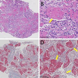 Histologic Findings Of Case 1 On Lung Biopsy Hematoxylin And Eosin