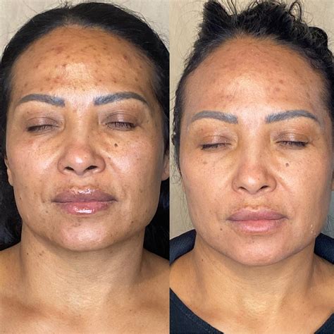 Microdermabrasion Before And After Results Pictures The Daily Glimmer