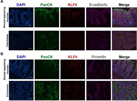 Immunofluorescence Staining For Panck Klf E Cadherin And Vimentin