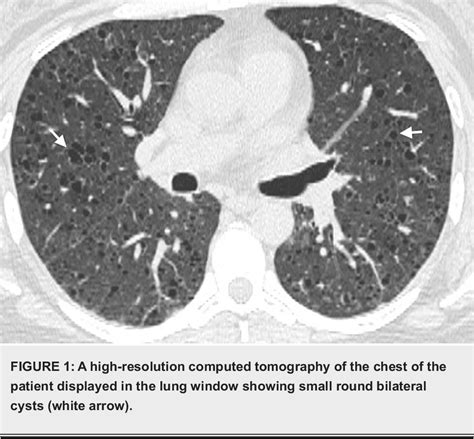 Figure 1 From Pulmonary Langerhans Cell Histiocytosis Masquerading As