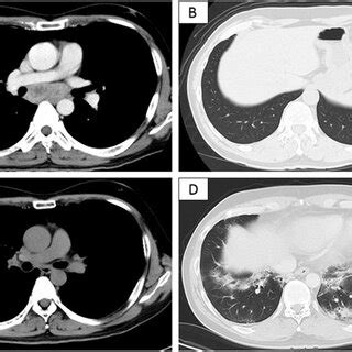 Progress Of Chest Computed Tomography CT Images A B Chest CT