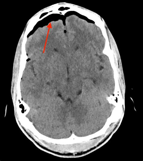 Traumatic Tension Pneumocephalus Ct Annotated Jetem Jetem