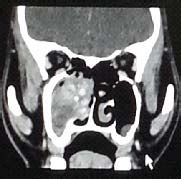 A Large Expansile Patchy Heterogeneous Enhancing Soft Tissue Mass