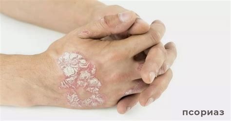 Псориаз и экзема в чем разница