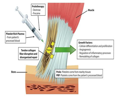 Prolotherapy — Purely Health Clinic