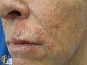 Shingles Rash: Mild, Early Stages, Pictures - eHealthStar