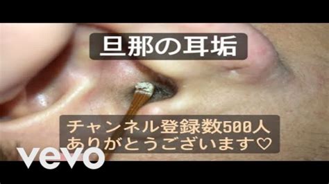 【耳かき】耳かき 耳掃除 耳垢の除去、外耳道のセルメンおよび真菌の処理 Vol 104 【ear Wax】 Youtube