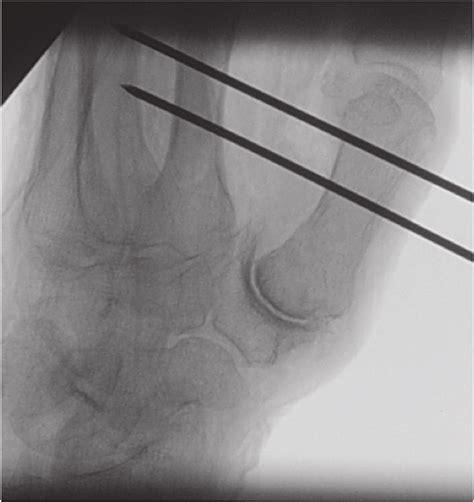 Fluoroscopy After Closed Reduction And Percutaneous Fixation Same