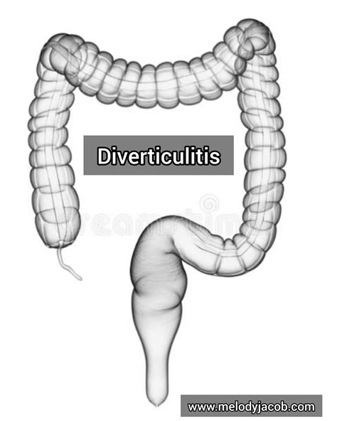 Diverticulitis Symptoms Causes Diagnosis Treatment Melody Jacob