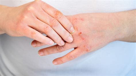 Eczema Atopic Dermatitis Toronto Dermatology Centre