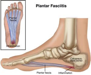 plantar fasciitis pro dynamic physical therapy