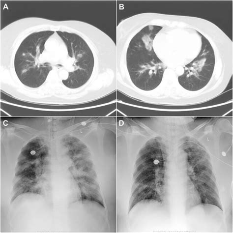 Chest Computed Tomography Ct And X Ray Images During Hospitalization Download Scientific