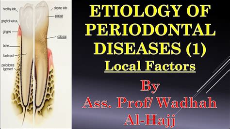 7 Etiology Of Periodontal Diseases 1local Factors Dr Wadhah