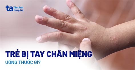 Bệnh Chân Tay Miệng Bôi Thuốc Gì Hướng Dẫn Điều Trị Hiệu Quả Và An Toàn