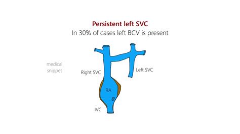 Persistent Left Superior Vena Cava Left Svc Embryology And Clinical