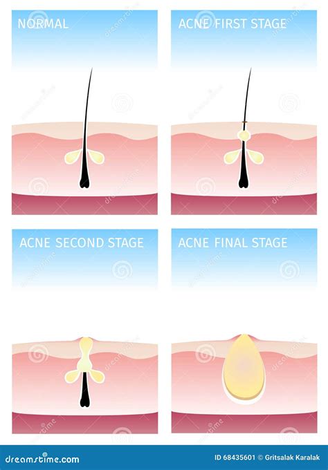 Stages Of Acne Formation In The Human Skin Cartoon Vector