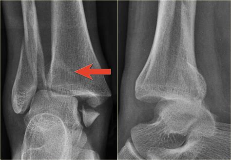 Icd Code For Right Distal Fibula Fracture