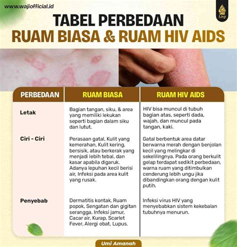 Perbedaan Ruam Kulit Biasa Dan Hiv Dan Cara Mudah Membedakannya