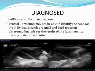 Amniotic Band Syndrom Epptx Ppt