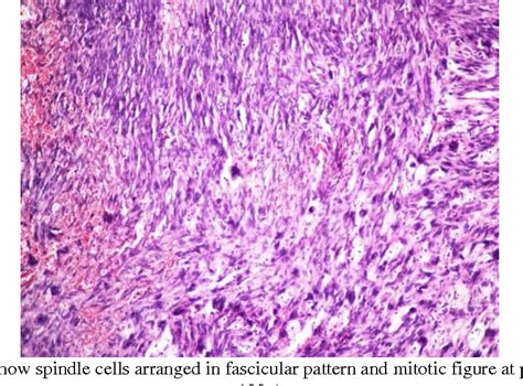 Figure 4 From Primary Ovarian Fibrosarcoma A Rare Case Report Semantic Scholar