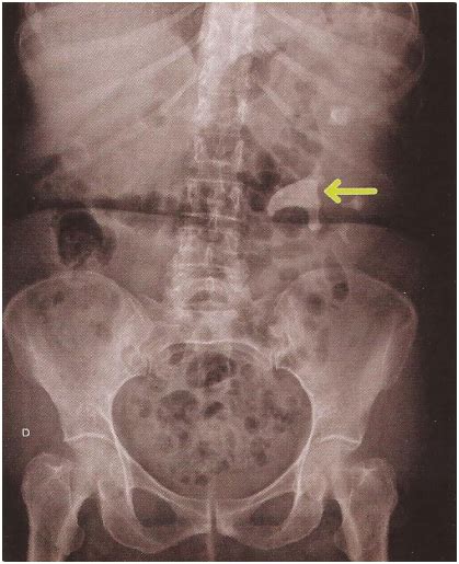 Radiografía renal y vesical simple Síntesis de Conocimientos