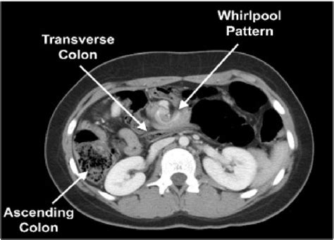 CT scan of the abdomen with contrast showing intestinal obstruction. | Download Scientific Diagram