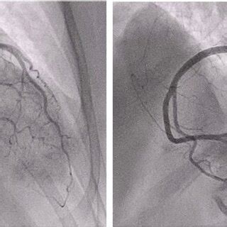 Coronary angiogram excluding progression of the coronary heart disease ...