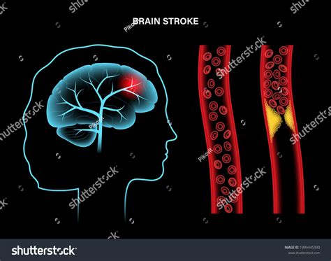 Ischemic Brain Stroke Normal Artery Arteriosclerosis Stock Vector