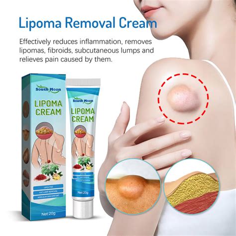 Lipoma Remove Cream Body Care Reduce Lipoma Fat Lumps Subcutaneous