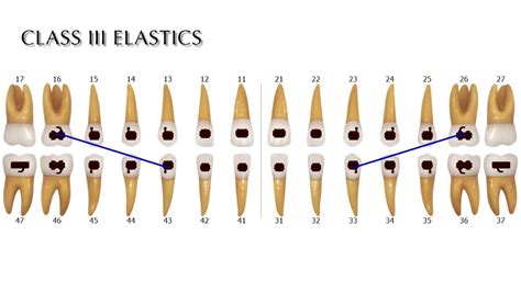 Class Iii Elastics Youtube