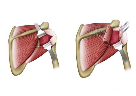 Shoulder Joint Capsule Surgery Photograph by Maurizio De Angelis/science Photo Library - Pixels