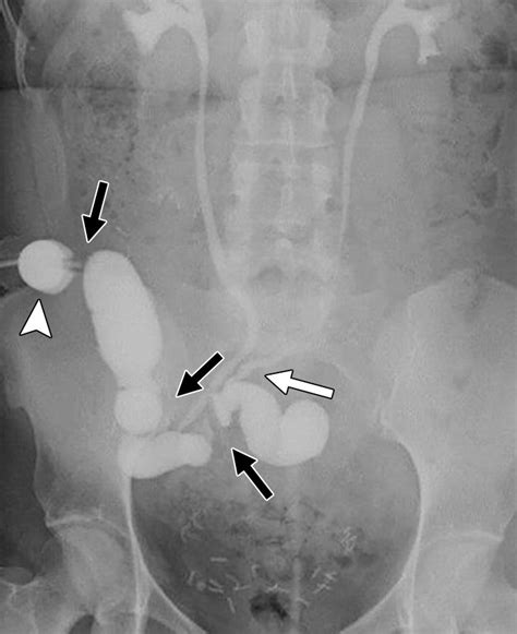 Follow The Stream Imaging Of Urinary Diversions RadioGraphics